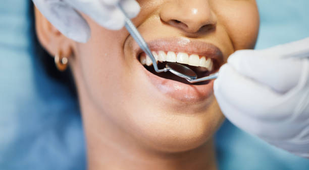 Best Emergency Dentist for Lost Fillings or Crowns in California, MD